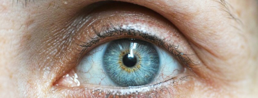 Göz Alerjisi Belirtileri Nelerdir? - Göz Alerjisi